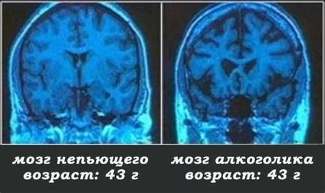 мозг алкоголика.jpg